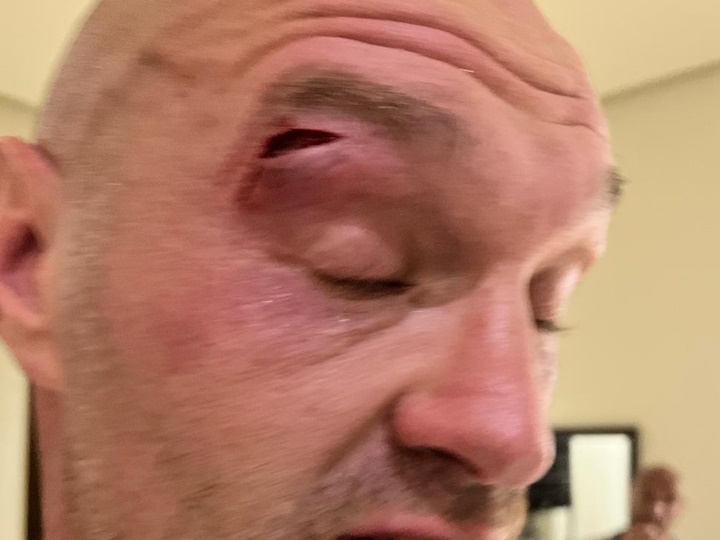 Tyson Fury se voit forcé de reporter son combat avec Oleksandr Usyk dû à une coupure à l’œil